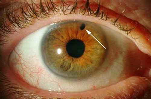 پیشگیری از بیماری آب سیاه چشم و نحوه درمان آن