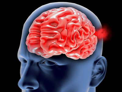 بیماری آنوریسم مغزی و یا کلاف مغزی