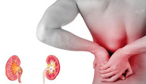 پیشگیری از سنگ کلیه با رعایت خوردن مواد غذایی