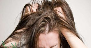 آکنه پوست سر